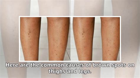 brown spots on skin on legs